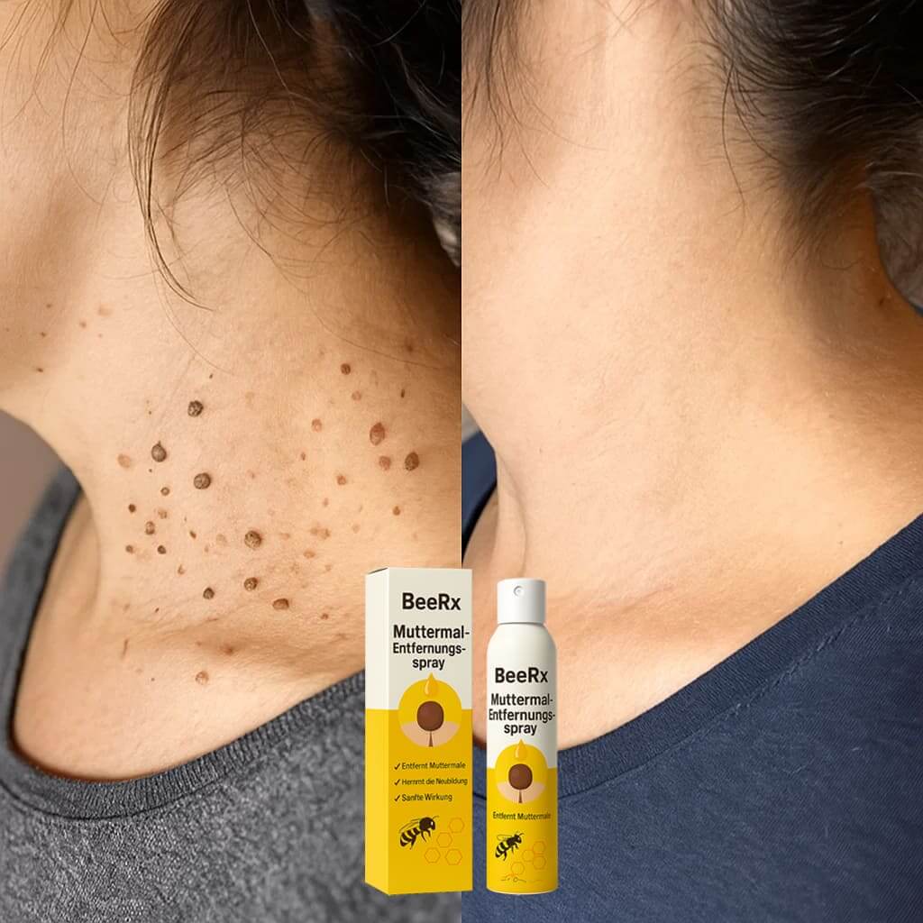 Before and after using BeeRx Muttermal-Entfernungsspray for mole and blemish reduction on skin.
