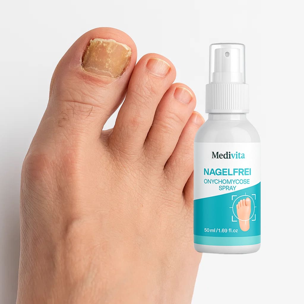 Medivita NagelFrei spray bottle next to a toenail with fungal infection, illustrating its use for nail care and fungus treatment.